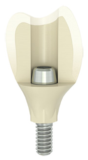 Atlantis crown abutment