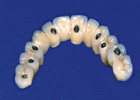 Angled Abutment System