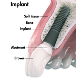 Dental Implant