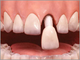 Cementation