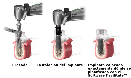 Guías quirúrgicas Facilitate™