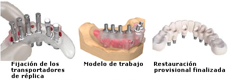 Guía quirúrgica Facilitate™