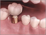 Cementation