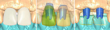 Virtual Abutment Design