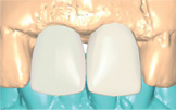Virtual Abutment Design