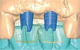 Virtual Abutment Design