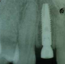 Radiografía postoperatoria