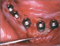 Las superficies de implante expuestas son las zonas previstas para el aumento.