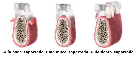 Guía quirúrgica Facilitate™